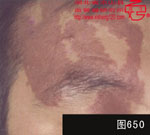 血管瘤病理图片图641-图660(图9)