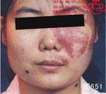 血管瘤病理图片图641-图660(图10)