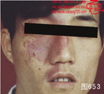 血管瘤病理图片图641-图660(图12)