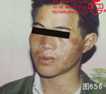 血管瘤病理图片图641-图660(图11)