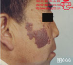 血管瘤病理图片图661-图680(图5)