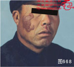 血管瘤病理图片图661-图680(图7)