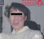 血管瘤病理图片图661-图680(图10)