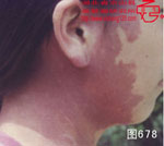 血管瘤病理图片图661-图680(图17)