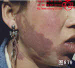 血管瘤病理图片图661-图680(图18)