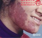 血管瘤病理图片图661-图680(图19)
