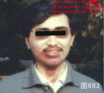 血管瘤病理图片图681-图700(图1)