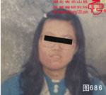 血管瘤病理图片图681-图700(图5)