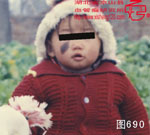 血管瘤病理图片图681-图700(图9)