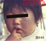 血管瘤病理图片图681-图700(图11)