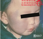 血管瘤病理图片图681-图700(图16)