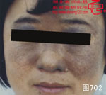 血管瘤病理图片图701-图720(图1)