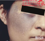血管瘤病理图片图701-图720(图5)