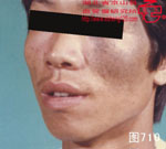 血管瘤病理图片图701-图720(图9)