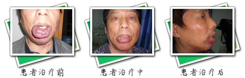 患者治疗前后对比(图1)