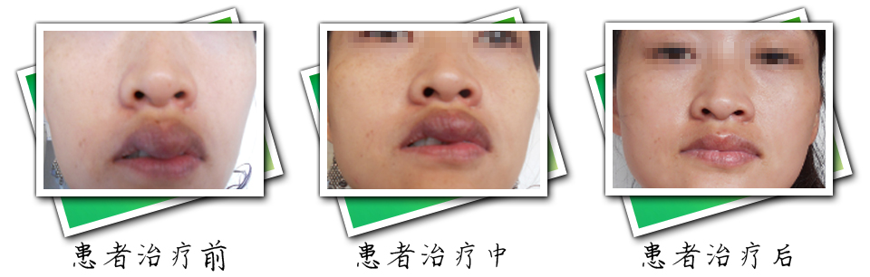 患者治疗前后对比(图2)